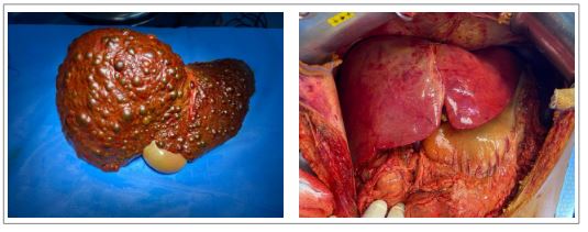 Explante, � esquerda, e enxerto ap�s reperfus�o, � direita.