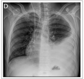 Radiografia do t�rax mostra derrame pleural no hemit�rax esquerdo.