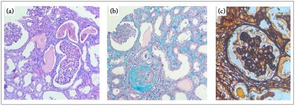 a) Colora��o: �cido peri�dico de Schiff (PAS), 40x. b) Colora��o: Tricr�mio de Masson, 40x. c) Colora��o: Prata metenamina de Jones, 100x. Par�nquima renal mostrando glom�rulos, dois deles globalmente escler�ticos. Par�nquima renal representado por regi�es corticais e medulares, duas delas globalmente escler�ticas, com �reas de hialinose. Pod�citos hipertr�ficos e hiperpl�sicos ao redor de al�as capilares colapsadas. A membrana basal est� difusamente enrugada, e as c�psulas de Bowman est�o ligeiramente espessadas. O interst�cio � dissociado por cord�es fibr�ticos (~20%) e cont�m um leve infiltrado inflamat�rio linfoc�tico. Os t�bulos est�o difusamente dilatados, com descama��o parcial, vacuoliza��o e atenua��o do epit�lio. A membrana basal tende a permanecer intacta. As art�rias e arter�olas interlobulares est�o preservadas. Os capilares peritubulares s�o pouco vis�veis. Imagens gentilmente cedidas pela Dra. Denise Maria Avancini C. Malheiros e Dr. Felipe Louren�o Ledesma.