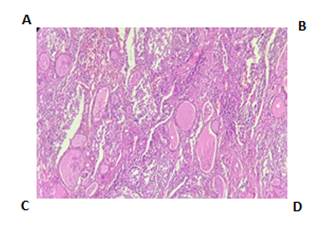 Anatomía Patológica. Coloración H y E. A: Imagen histológica a 40x, se observa el tejido tiroideo (folículos) parcialmente reemplazado por la lesión con vaga nodularidad. (Mitad izquierda tiroides poco conservada-mitad derecha lesión). B: Imagen histológica a 100x, folículos tiroideos y lesión. C: Imagen histológica a 400x, donde se observa infiltrado mixto de células mononucleares con citoplasma eosinófilo, núcleo grande, algunas de ellas con hendiduras. Se nota también gran cantidad de eosinófilos. D: Imagen histológica a 400x. Se nota también una célula gigante multinucleada.