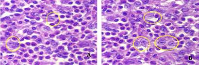 Células histiocíticas/eosinofilicas. Coloración H y E. A y B: Hay numerosas células de Langerhans (núcleo redondo u ovalado, membrana nuclear nítida, cromatina fina con hendidura o nucleolo pequeño), solo algunas están marcadas con el círculo amarillo.