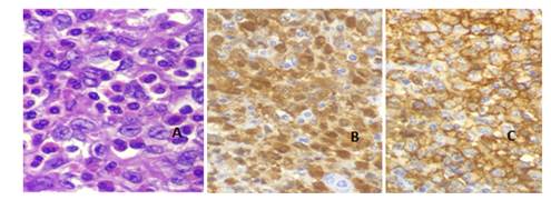 Inmunohistoquímica. A: tinción H y E. B: S-100. C: CD1a. 