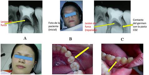 Paciente de 6 años de edad que recibe tratamiento endodóntico con la pasta CDZ. A. Radiografía del diente 85 donde se observa lesión de furca y extravasación del material. B. Foto de la paciente al momento de la realización de la terapia endodóntica. C. Radiografía del diente 85 tratado donde se observa la desaparición de la lesión de furca y el contacto del germen con la pasta extravasada CDZ. D-F. Paciente con el diente permanente erupcionado sin signos de alteración del esmalte, ocho años después del tratamiento con CDZ.