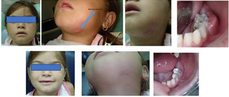 Paciente de 5 años de edad, con un problema de absceso en una pieza temporaria. La patología incluía a los dos molares inferiores temporarios del lado izquierdo #74 y #75. Edema extraoral. Se observa la pieza 74 y 75 con afeccion pulpar, y edema de encia, caracteristico de las piezas temporaria. Luego de 3 dias posterior a la aplicación de la terapia pulpar con CDZ, se observa intra y extra oralmente una reparacion del tejido blando, ademas de la cesacion de todos los sintomas