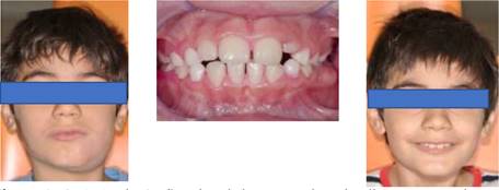 Paciente de 8 años de edad, que acude a la clínica por un absceso dentoalveolar de la pieza 74, que presenta una caries extensa. Luego de realizar la terapia pulpar con la técnica de CDZ, se observa normalización de los tejidos blandos y desaparición de los síntomas.