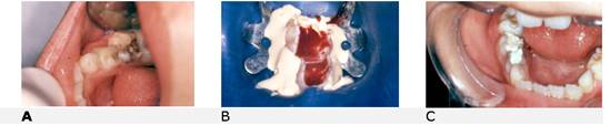 Paciente de 5 años con un absceso pos vestibular (A). Al momento del acceso a la cámara pulpar, se presenta un sangrado profuso, que es característico de las pulpas de dientes temporarios (B). Se aplica un hemostático para la contención de la hemorragia. C. Control a los 7 días posterior a la terapia pulpar con CDZ con desaparición del absceso gingival.