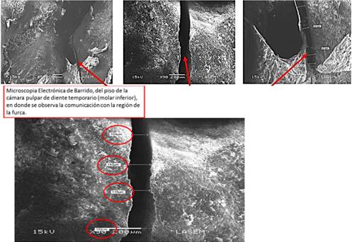 Microscopia EleM, ctrónica de Barrido, del piso de la cámara pulpar de diente temporario (molar inferior), en donde se observa la comunicación con la región de la furca.