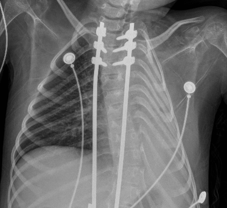 Radiografa de trax. Primer da de internacin.