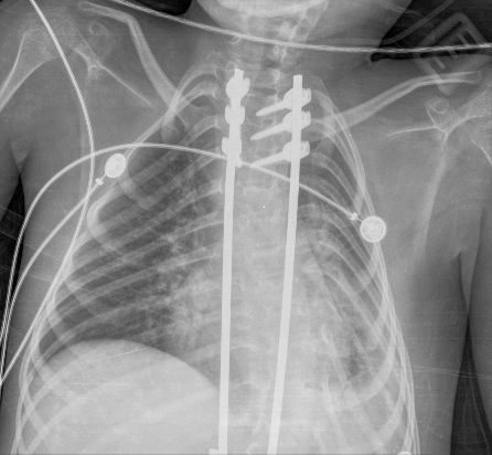 Radiografa de trax. Quinto da de internacin.