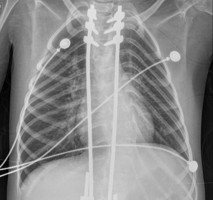 Radiografa de trax. Sptimo da de internacin.
