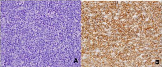 A) C�lulas neopl�sicas grandes, redondas con patr�n de crecimiento difuso (H&E 40X). B) C�lulas positivas difusas al CD 20 marcador de linfocitos B.