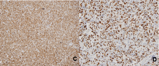C) Positividad de membrana CD 79a. D) �ndice de proliferaci�n tumoral alto mediante el Ki-67.