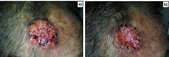 Lesin tumoral localizada en el cuero cabelludo.
