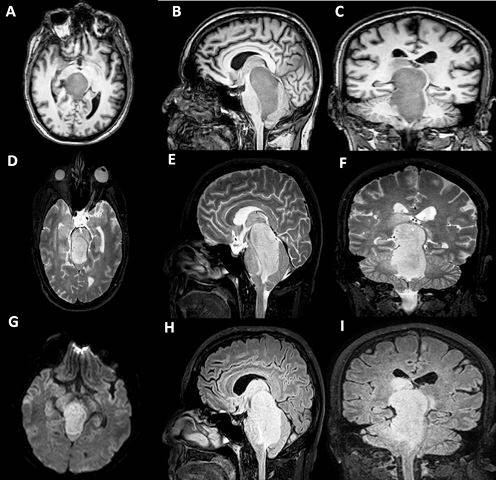 A-C) Im�genes potenciadas en T1. D-F) Im�genes potenciadas en T2. G) IRM por difusi�n, corte axial. H-I) FLAIR. Se aprecia lesi�n tumoral ponto-mesenf�lica extr�nsica. (Fuente: Historia cl�nica)
