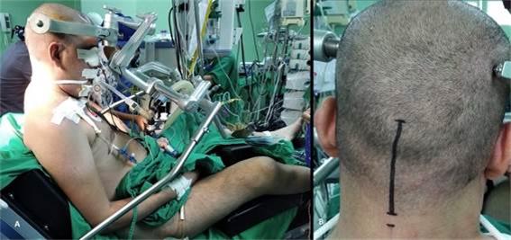 A) Posici�n semisentado. B) Marcaje de incisi�n. (Fuente: Historia cl�nica)