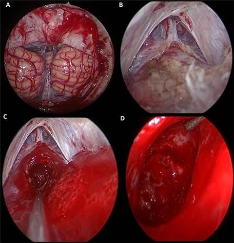 A) Vista panor�mica de corredor supracerebeloso infratentorial. B) Lesi�n tumoral en margen inferior de la imagen, se aprecia c�pula tentorial por detr�s de la misma. C-D) Lecho tumoral luego del debulking por t�cnica de doble aspiraci�n. (Fuente: Historia cl�nica)