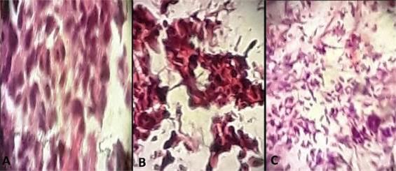 Imagen de biopsia con coloraci�n de hematoxilina/eosina. (Fuente: Historia cl�nica)