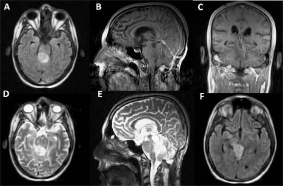 A-C y F) Im�genes potenciadas en T1. D-E) Im�genes potenciadas en T2. Obs�rvese control de la lesi�n tumoral a los 6 meses. (Fuente: Historia cl�nica)