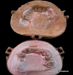 Acrilado y desencerado de pr�tesis PEEK