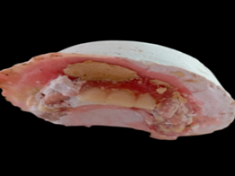 Liberaci�n de pr�tesis