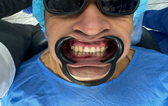 Entrega, prueba y adaptaci�n de pr�tesis PEEK en paciente.