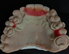 Enfilado de pr�tesis PEEK