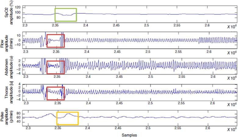 Possible episode of apnoea. Decrease in peripheral oxygen saturation (SpO2) (green), behaviour of flow signals and thoracoabdominal effort (red) and increase in cardiac pulse (yellow).