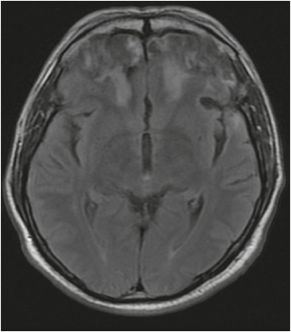Resonancia cerebral simple que muestra áreas de encefalomalacia en los polos frontales bilaterales y la corteza orbitofrontal, así como gliosis en la sustancia blanca profunda bilateral. Secuencia FLAIR, corte axial.