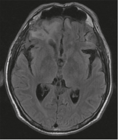 Resonancia cerebral simple que muestra zonas de contusión hemorrágica en la corteza orbitofrontal bilateral, de predominio derecho. Secuencia FLAIR, corte axial.