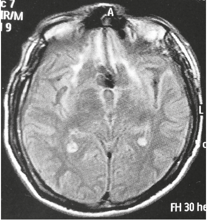 Resonancia cerebral simple que muestra zonas de encefalomalacia en el córtex prefrontal ventromedial y zonas de gliosis bilaterales en los giros rectos del córtex orbitofrontal. Secuencia FLAIR, corte axial.