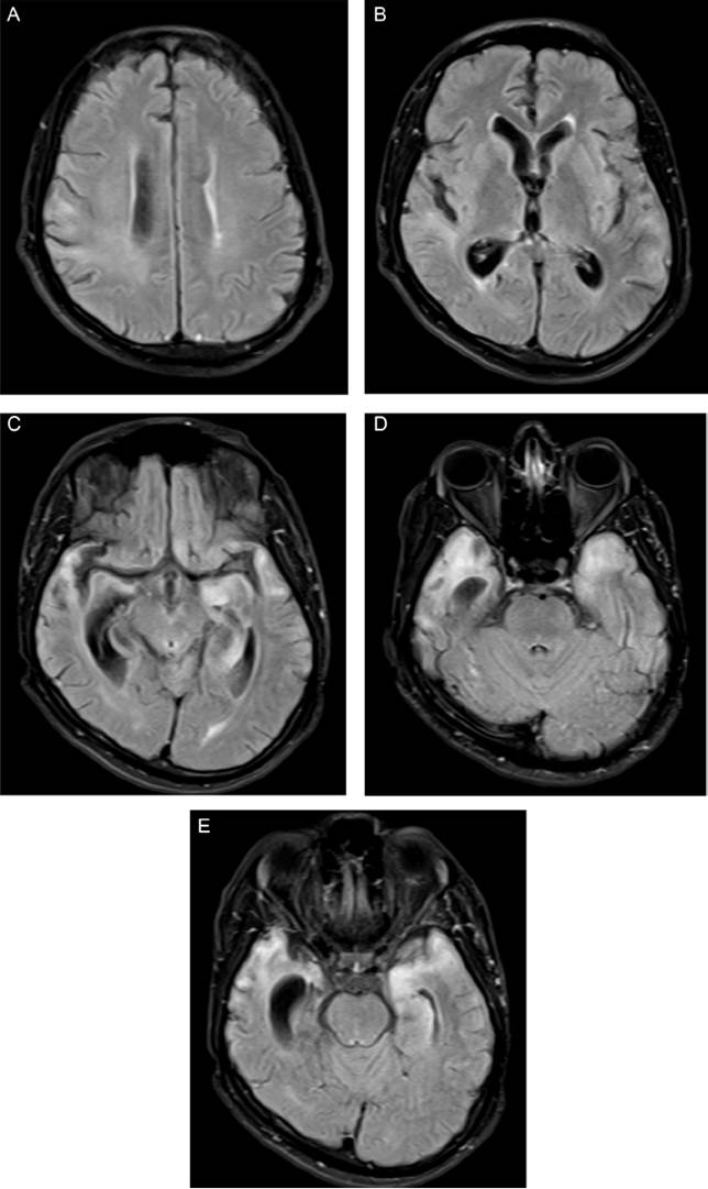 Im&aacute;genes axiales de resonancia magn&eacute;tica en secuencias FLAIR a diferentes niveles del enc&eacute;falo. A y B: se observan &aacute;reas de hiperintensidad de se&ntilde;al en la sustancia blanca de la corona radiada y a nivel subcortical, de predominio en el hemisferio cerebral derecho, as&iacute; como prominencia del sistema ventricular por p&eacute;rdida de volumen del par&eacute;nquima. C-E: extensa afecci&oacute;n de los l&oacute;bulos temporales, que son hiperintensos y atr&oacute;ficos, m&aacute;s evidentemente en el lado derecho, y generan dilataci&oacute;n compensatoria del cuerno temporal del ventr&iacute;culo lateral (im&aacute;genes aportadas por Ana Lorena Abello, del Hospital Universitario del Valle Evaristo Garc&iacute;a ESE).