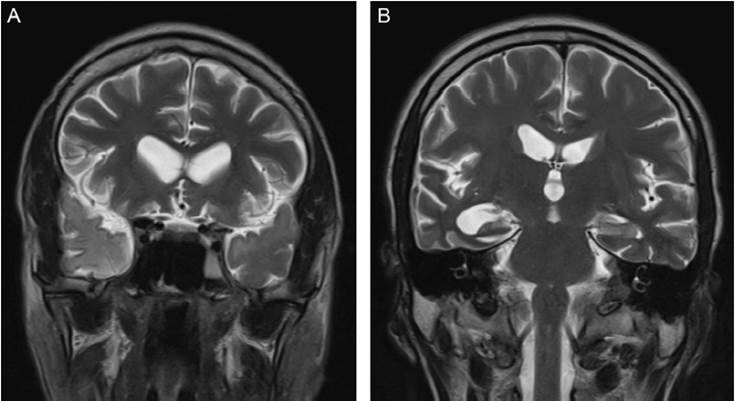 Im&aacute;genes coronales de resonancia magn&eacute;tica en secuencias T2, que muestran la especial afecci&oacute;n de los l&oacute;bulos temporales. A: hiperintensidad de se&ntilde;al anormal en el polo temporal derecho (flechas azules). B: dilataci&oacute;n del cuerno temporal derecho y afecci&oacute;n de la regi&oacute;n mesial temporal izquierda, que es anormalmente hiperintensa (flecha negra) (im&aacute;genes aportadas por Ana Lorena Abello, del Hospital Universitario del Valle Evaristo Garc&iacute;a ESE).