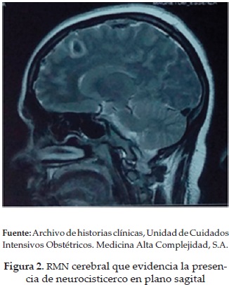 RMN cerebral que evidencia la presenciade neurocisticerco en plano sagital