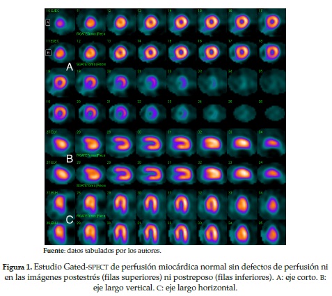Estudio Gated-SPECT de perfusión miocárdica normal sin defectos de perfusión nien las imágenes postestrés (filas superiores) ni postreposo (filas inferiores). A: eje corto. B:eje largo vertical. C: eje largo horizontal.