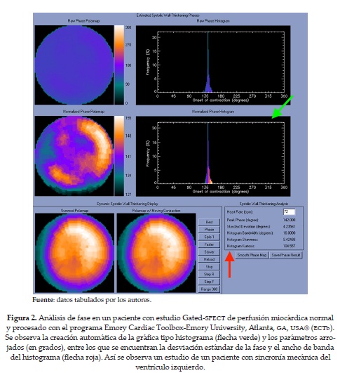 Análisis de fase en un paciente con estudio Gated-SPECT de perfusión miocárdica normaly procesado con el programa Emory Cardiac Toolbox-Emory University, Atlanta, GA, USA® (ECTb).Se observa la creación automática de la gráfica tipo histograma (flecha verde) y los parámetros arrojados(en grados), entre los que se encuentran la desviación estándar de la fase y el ancho de bandadel histograma (flecha roja). Así se observa un estudio de un paciente con sincronía mecánica delventrículo izquierdo.