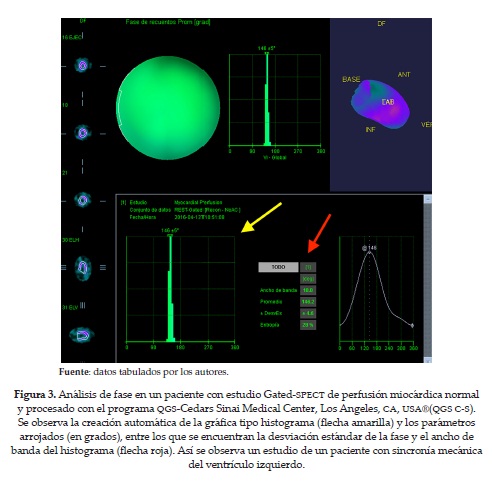 Análisis de fase en un paciente con estudio Gated-SPECT de perfusión miocárdica normaly procesado con el programa QGS-Cedars Sinai Medical Center, Los Angeles, CA, USA®(QGS C-S).Se observa la creación automática de la gráfica tipo histograma (flecha amarilla) y los parámetrosarrojados (en grados), entre los que se encuentran la desviación estándar de la fase y el ancho debanda del histograma (flecha roja). Así se observa un estudio de un paciente con sincronía mecánicadel ventrículo izquierdo.