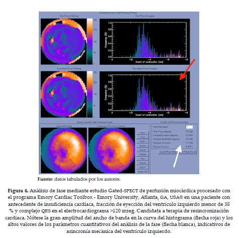 Análisis de fase mediante estudio Gated-SPECT de perfusión miocárdica procesado conel programa Emory Cardiac Toolbox - Emory University, Atlanta, GA, USA® en una paciente conantecedente de insuficiencia cardiaca, fracción de eyección del ventrículo izquierdo menor de 35% y complejo QRS en el electrocardiograma >120 mseg. Candidata a terapia de resincronizacióncardiaca. Nótese la gran amplitud del ancho de banda en la curva del histograma (flecha roja) y losaltos valores de los parámetros cuantitativos del análisis de la fase (flecha blanca), indicativos deasincronía mecánica del ventrículo izquierdo.