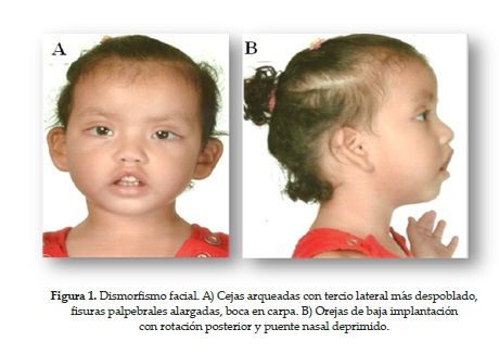 Dismorfismo facial. A) Cejas arqueadas con tercio lateral más despoblado,fisuras palpebrales alargadas, boca en carpa. B) Orejas de baja implantacióncon rotación posterior y puente nasal deprimido.