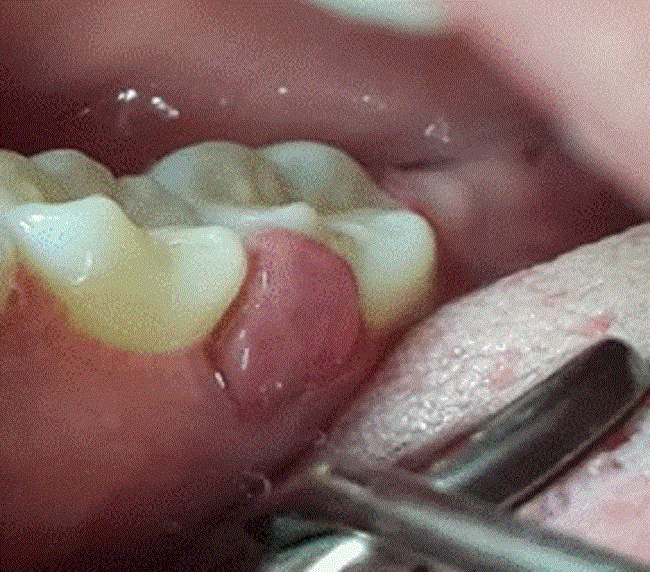 Lesión tumoral recidivante y sangrante superficial