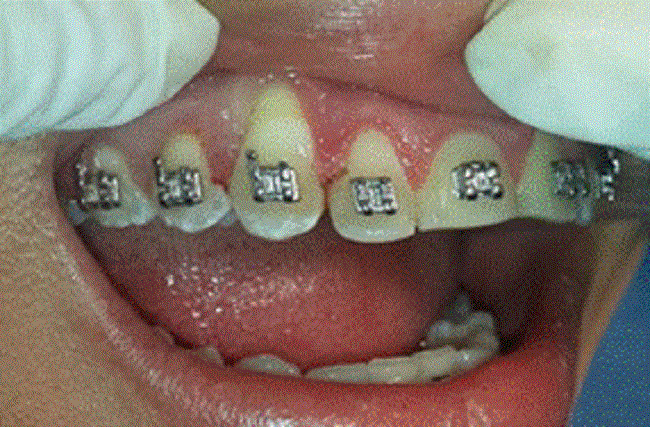 Aspecto de área quirúrgica, durante la vaporización del epitelio de encía con láser Teniendo en cuenta el sangrado de las lesiones, el impedimento de las funciones bucales y afectación de la calidad de vida, el carácter de satelitosis y recurrencia de la patología, se decidió la eliminación quirúrgica de lesión ubicada en encía papilar entre del 46-47, estudio histopatológico y gingivoplastia, en otras zonas afectadas. Debido al riesgo de hemorragia, el número de lesiones y la extensión del procedimiento se programó el abordaje quirúrgico con láser de diodo. 