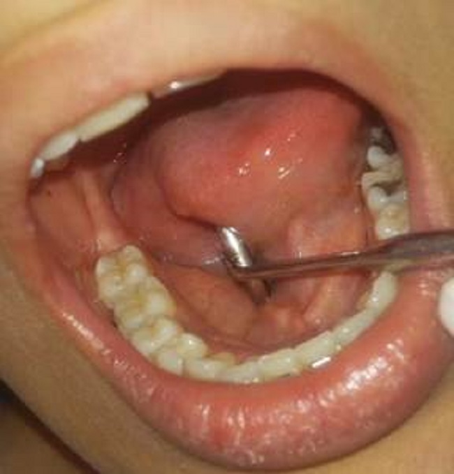 Aspecto de la encía 15 días postratamiento