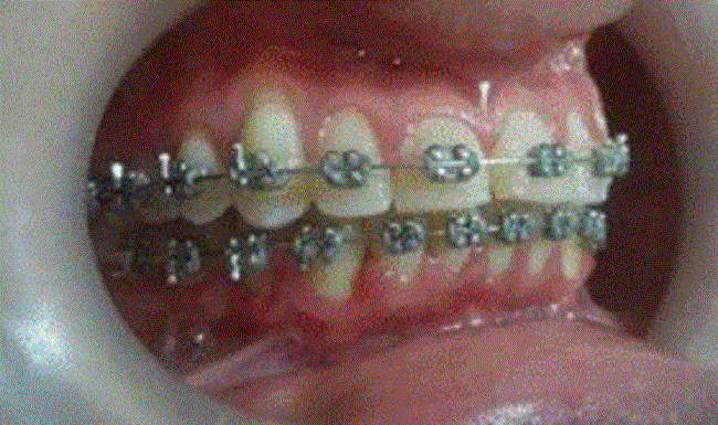 Aspecto gingival después del parto, reintegro de tratamiento ortodoncia