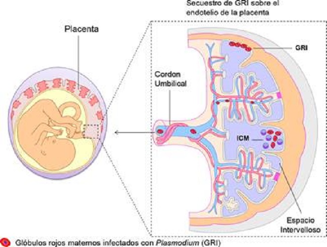 Mecanismo de la malaria cong&eacute;nita. La malaria cong&eacute;nita es ocasionada por la transmisi&oacute;n transplacentaria de formas asexuales del Plasmdium durante el embarazo. La infecci&oacute;n de la placenta se acompa&ntilde;a de infiltrados intervellosos de c&eacute;lulas mononucleares (ICM), los cuales originan cambios patol&oacute;gicos en los trofoblastos, que facilitan la entrada transplacentaria de eritrocitos infectados al feto.