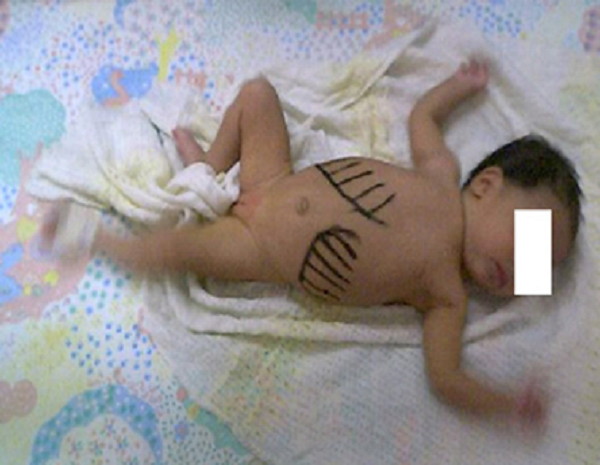 Paciente con malaria cong&eacute;nita. Imagen del abdomen de la paciente mostrando hepatoesplenomegalia. Abdomen blando, depresible, h&iacute;gado palpable 4 cm por debajo del reborde costal derecho y bazo palpable 2 cm por debajo de reborde costal izquierdo.