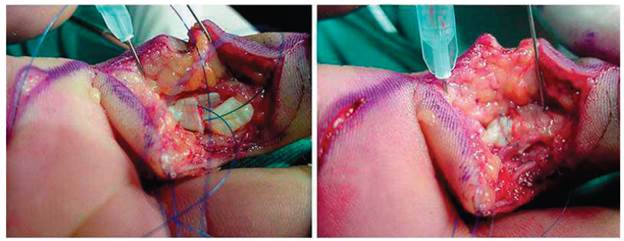 Design of modified Kessler suture in zone II of finger flexor with epitendinous suture