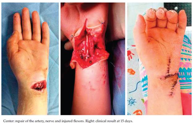 Flexor tendon injury in zone V in ulnar border of the wrist with ulnar artery and nerve injury