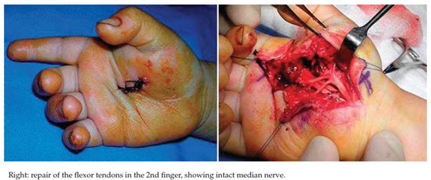 Zone III flexor injuries
