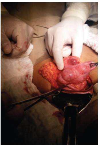 Pieza quir&uacute;rgica. Se observa el divert&iacute;culo con signos de inflamaci&oacute;n