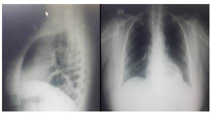 Radiografía de tórax, lateral y antero-posterior. Obsérvese imagen retrocardiaca con nivel hidroáereo