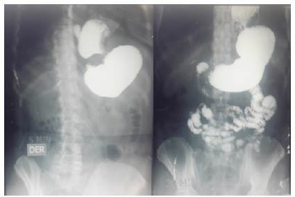 Serie digestiva alta preoperatoria. Obsérvese la imagen en reloj de arena y el paso del contraste hacia el intestino delgado
